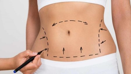 Karın Germe Ameliyatı – BSHA